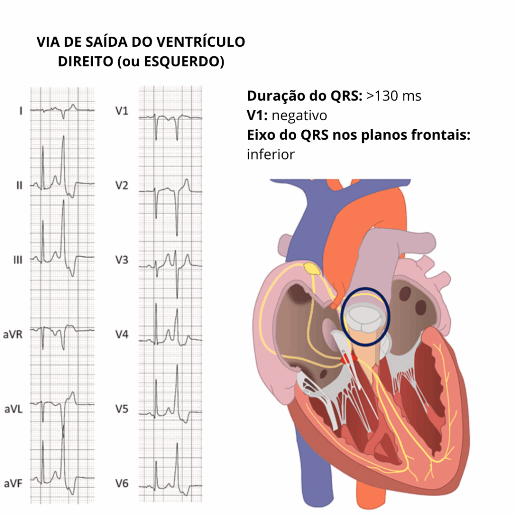Eletrocardiograma mostrando extrassístole ventricular com QRS largo (>130 ms), V1 negativo e eixo inferior, típica de origem na via de saída do ventrículo direito ou esquerdo.