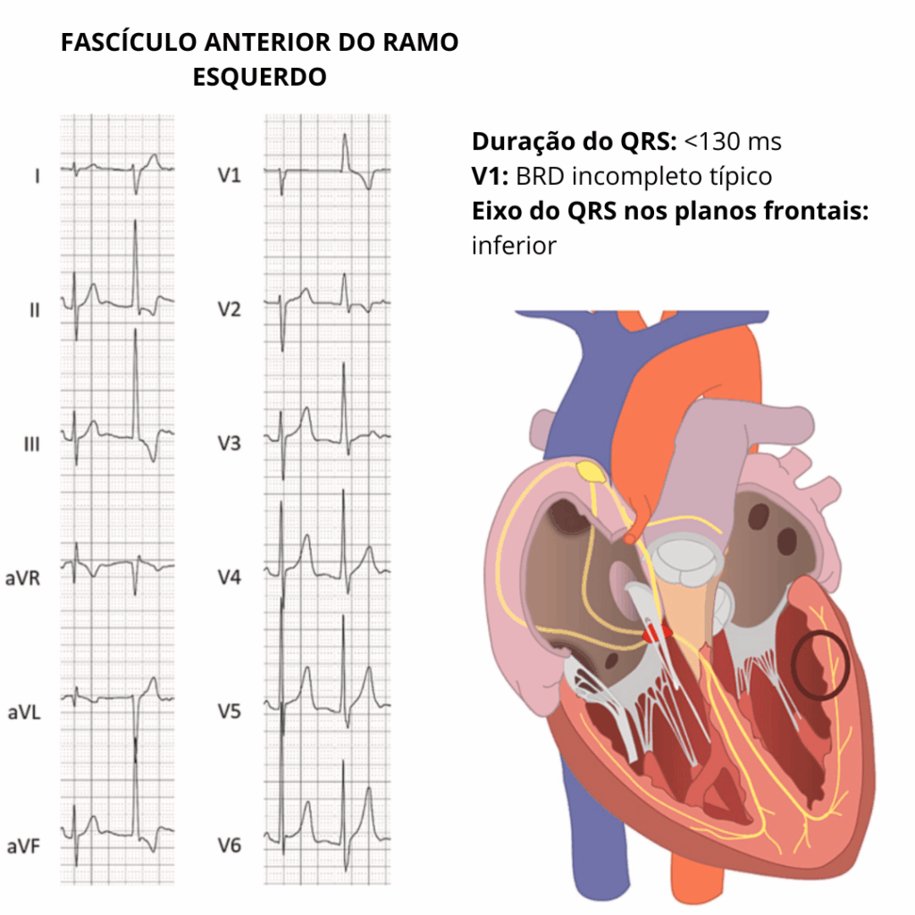 ECG com extrassístole ventricular apresentando QRS