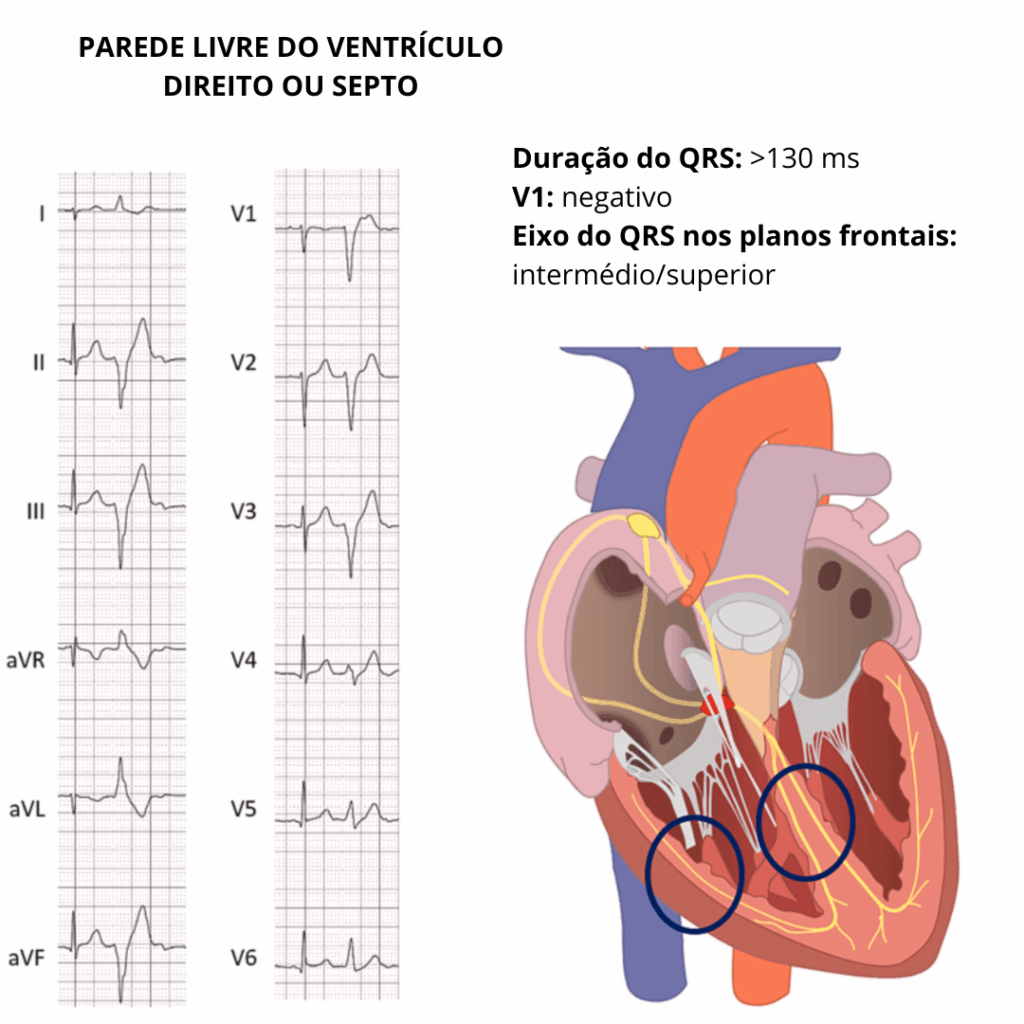 Eletrocardiograma demonstrando extrassístole ventricular com QRS largo (>130 ms), V1 negativo e eixo intermediário/superior, compatível com foco na parede livre do ventrículo direito ou