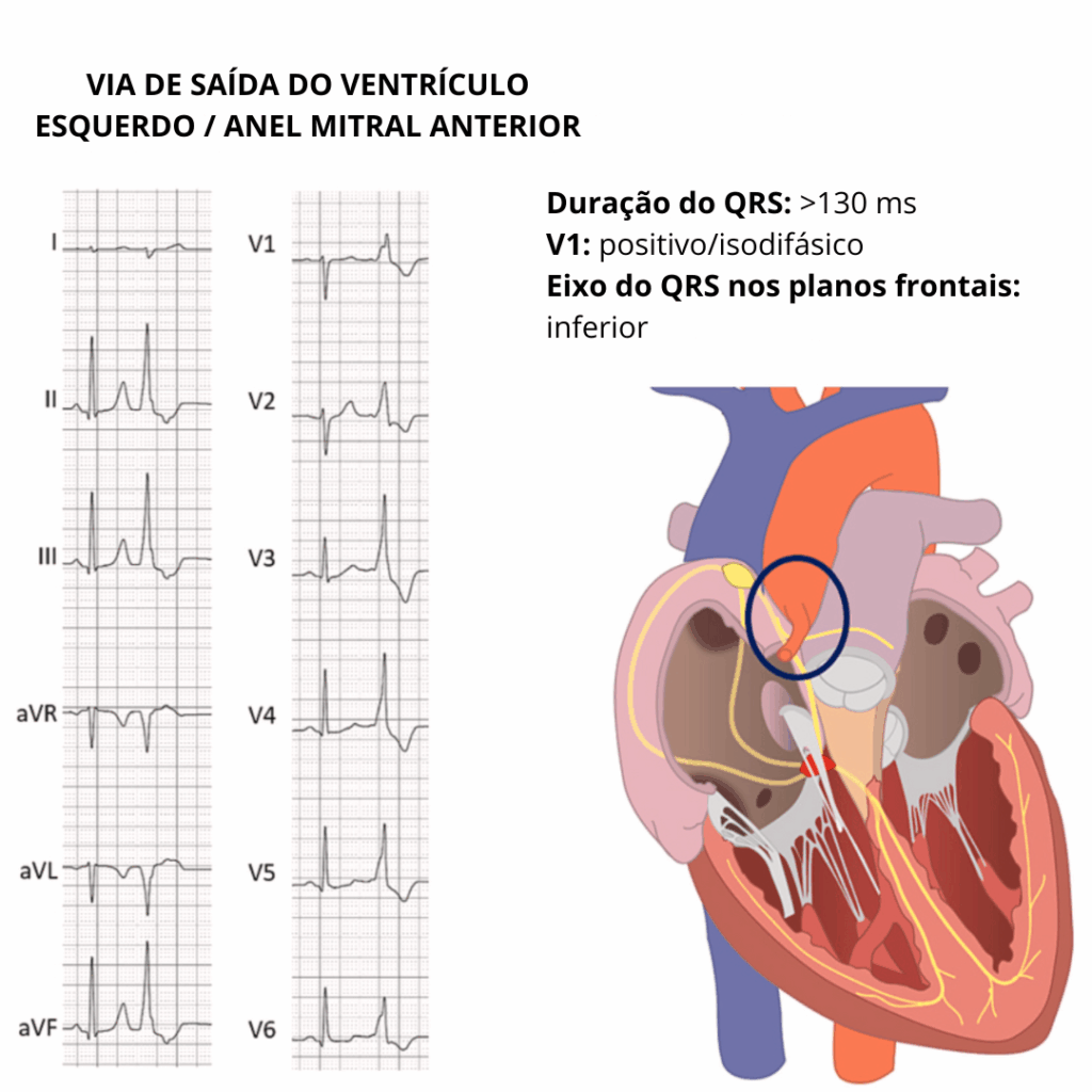 ECG com extrassístole ventricular de QRS largo (>130 ms), V1 positivo/isodifásico e eixo inferior, indicando foco na via de saída do ventrículo esquerdo ou anel mitral anterior.