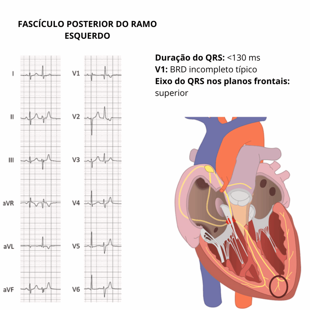 Eletrocardiograma apresentando extrassístole ventricular com QRS