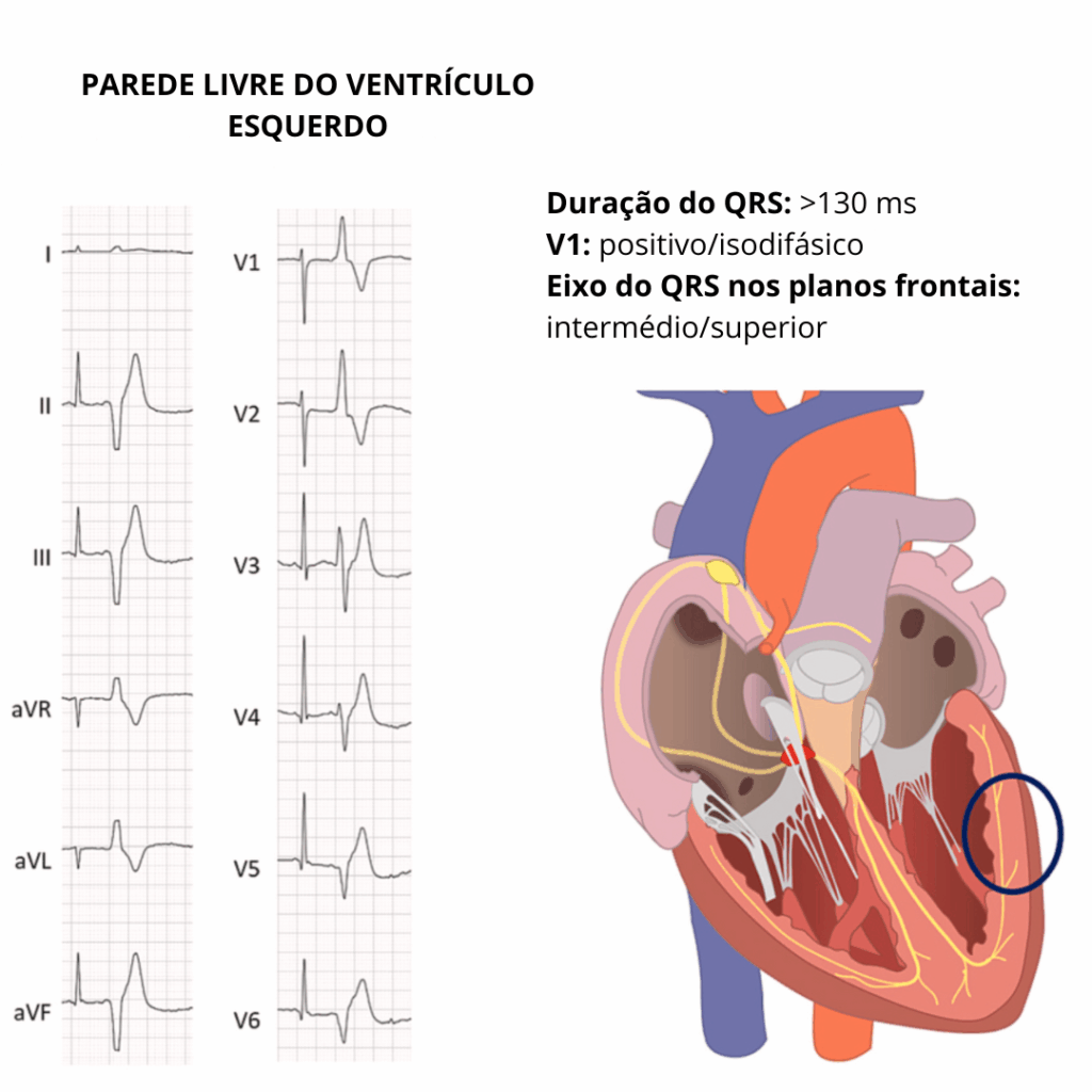 Eletrocardiograma com extrassístole ventricular de QRS largo (>130 ms), V1 positivo/isodifásico e eixo intermediário/superior, compatível com foco na parede livre do ventrículo esquerdo.