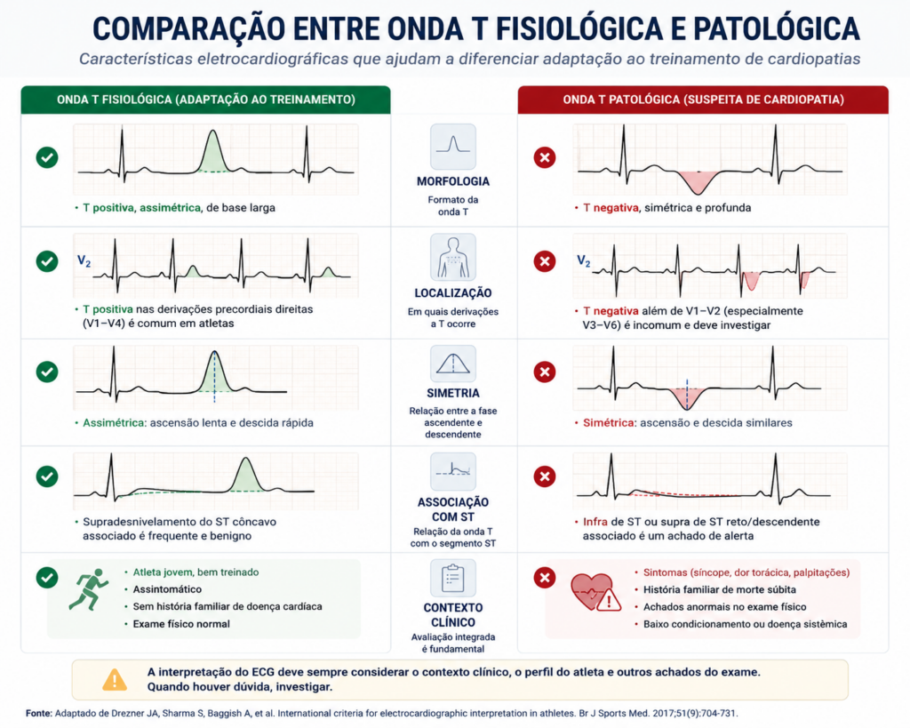Esquema comparando as definições clássicas e modernas de repolarização precoce no ECG, destacando elevação do ponto J, onda J (notch), slurring terminal do QRS e supradesnivelamento do segmento ST, padrões frequentemente observados em atletas saudáveis.