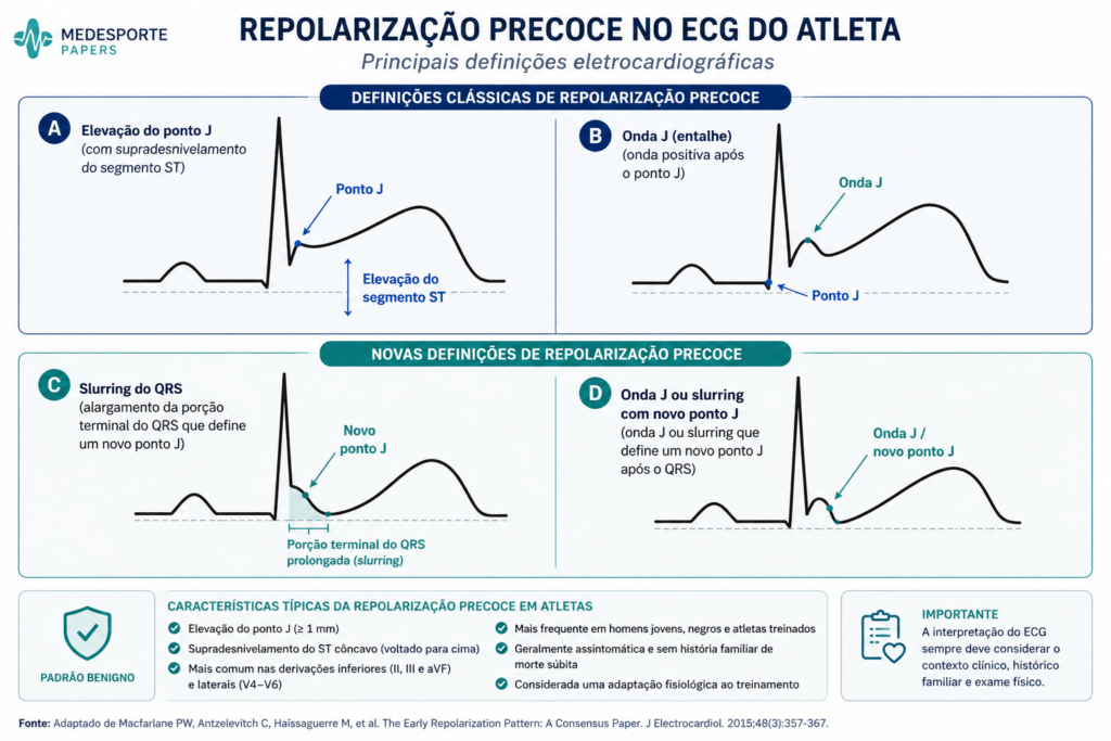 Esquema mostrando as definições clássicas e atuais de repolarização precoce no ECG, com destaque para elevação do ponto J, onda J, slurring terminal do QRS e supradesnivelamento do segmento ST, alterações frequentemente observadas em atletas saudáveis.