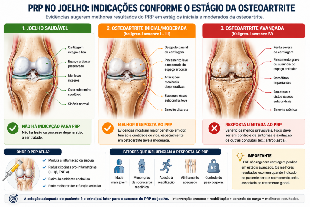 Infográfico comparando um joelho saudável, osteoartrite inicial/moderada e osteoartrite avançada, destacando as principais indicações do PRP no joelho, os estágios da degeneração articular e os casos em que o tratamento tende a apresentar melhores resultados clínicos.